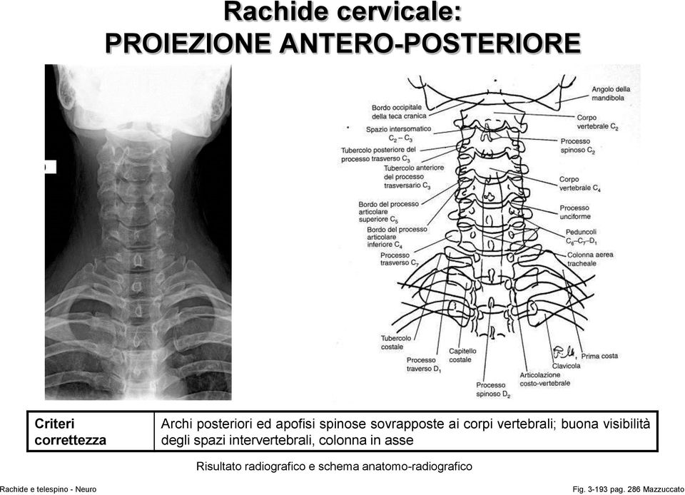 spazi intervertebrali, colonna in asse Risultato radiografico e schema