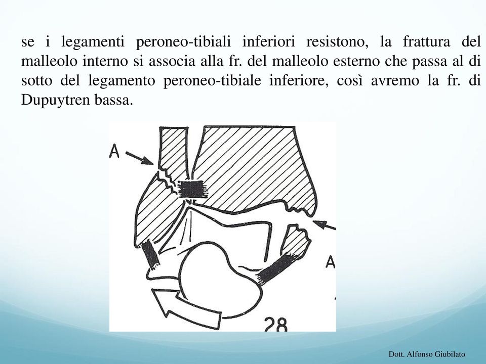 del malleolo esterno che passa al di sotto del legamento