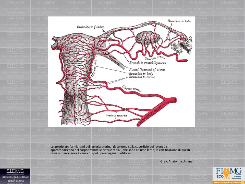 arterie radiali, che sono a flusso lento; la calcificazione di