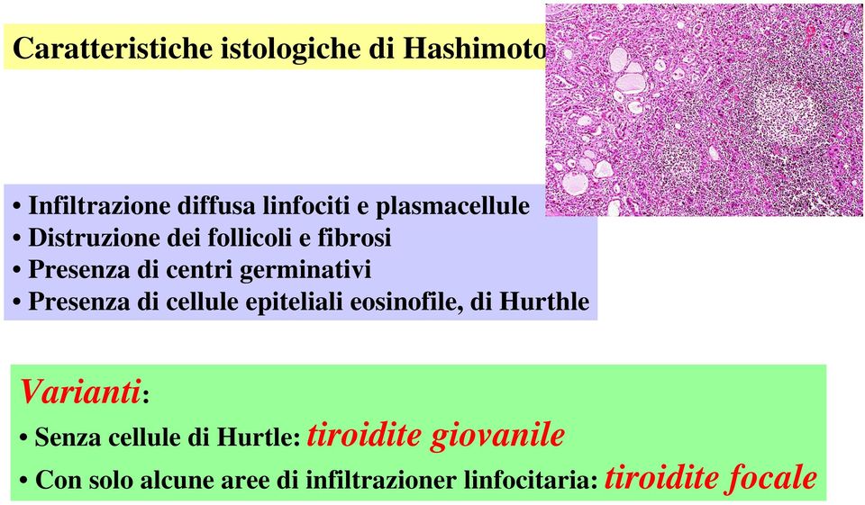 Presenza di cellule epiteliali eosinofile, di Hurthle Varianti: Senza cellule di