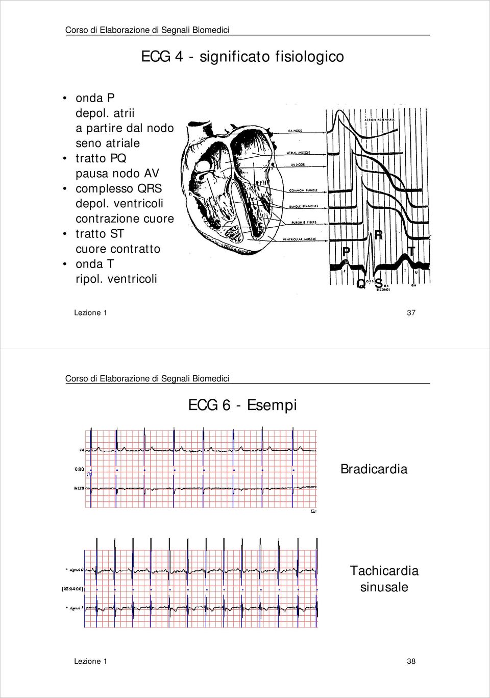 ventricoli contrazione cuore tratto ST cuore contratto onda T ripol.