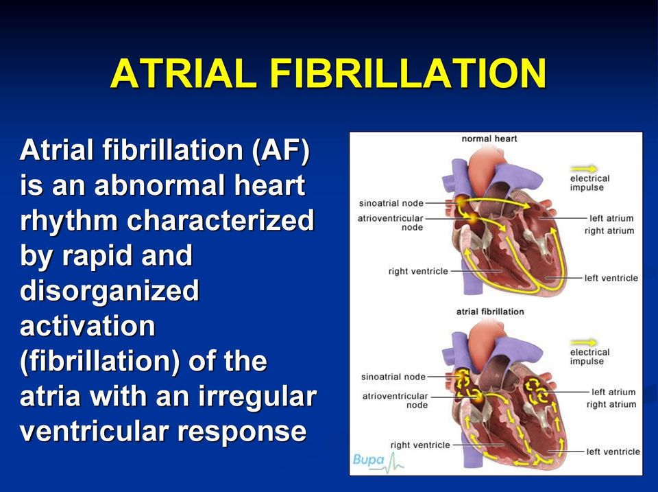 and disorganized activation (fibrillation) of