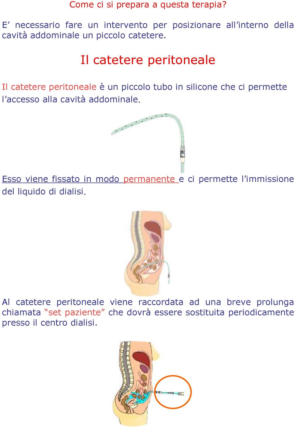 Il catetere peritoneale Il catetere peritoneale è un piccolo tubo in silicone che ci permette l accesso alla cavità addominale.