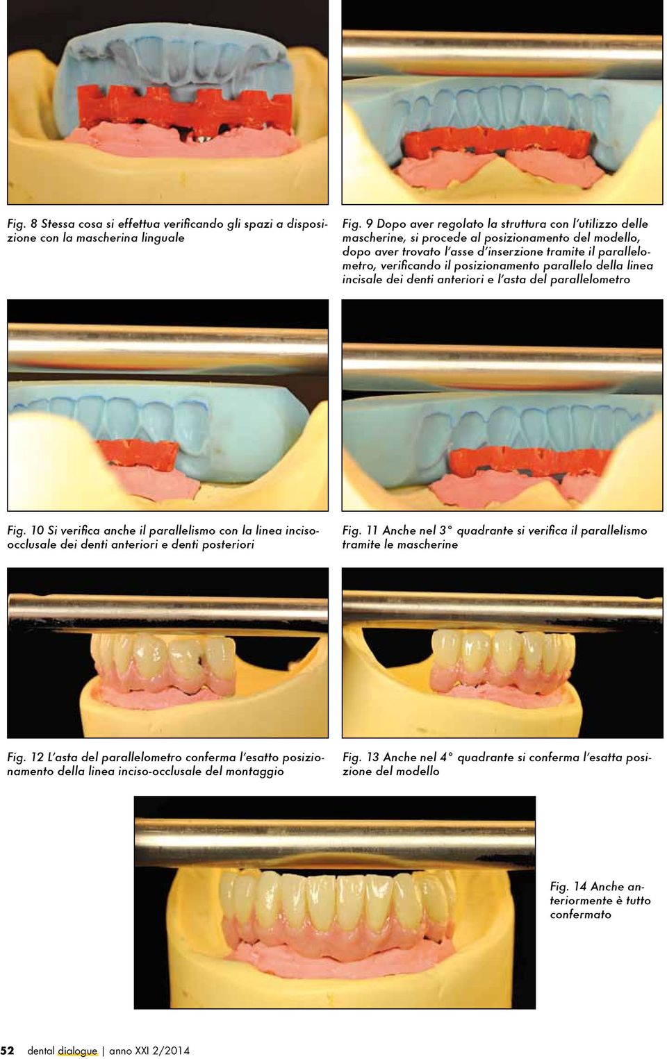 posizionamento parallelo della linea incisale dei denti anteriori e l asta del parallelometro Fig.