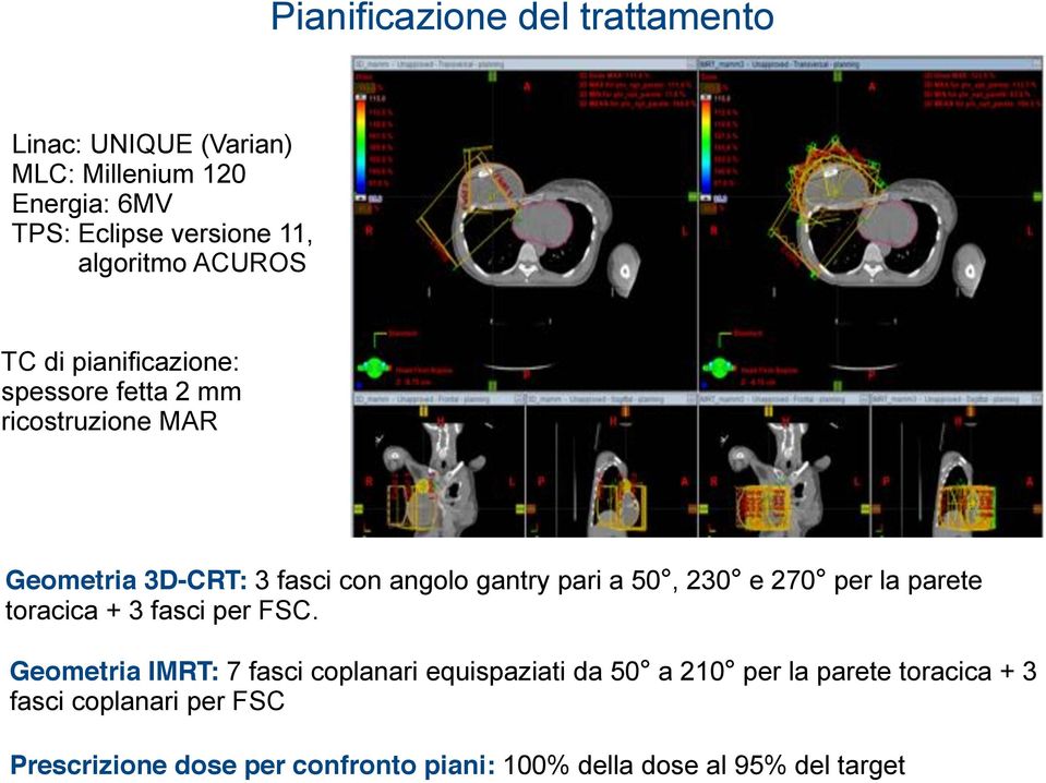 gantry pari a 50, 230 e 270 per la parete toracica + 3 fasci per FSC.