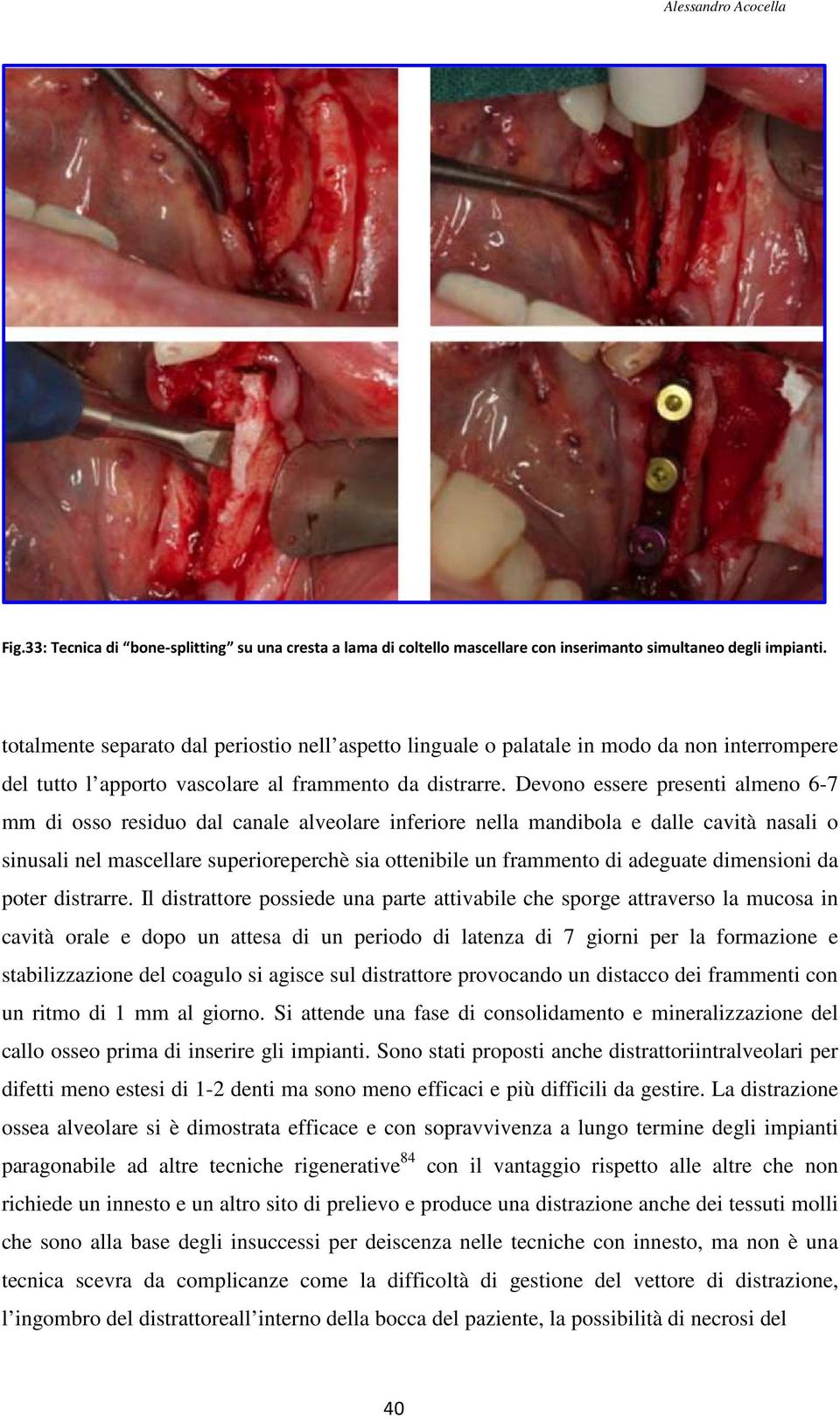 Devono essere presenti almeno 6-7 mm di osso residuo dal canale alveolare inferiore nella mandibola e dalle cavità nasali o sinusali nel mascellare superioreperchè perchè sia ottenibile un frammento