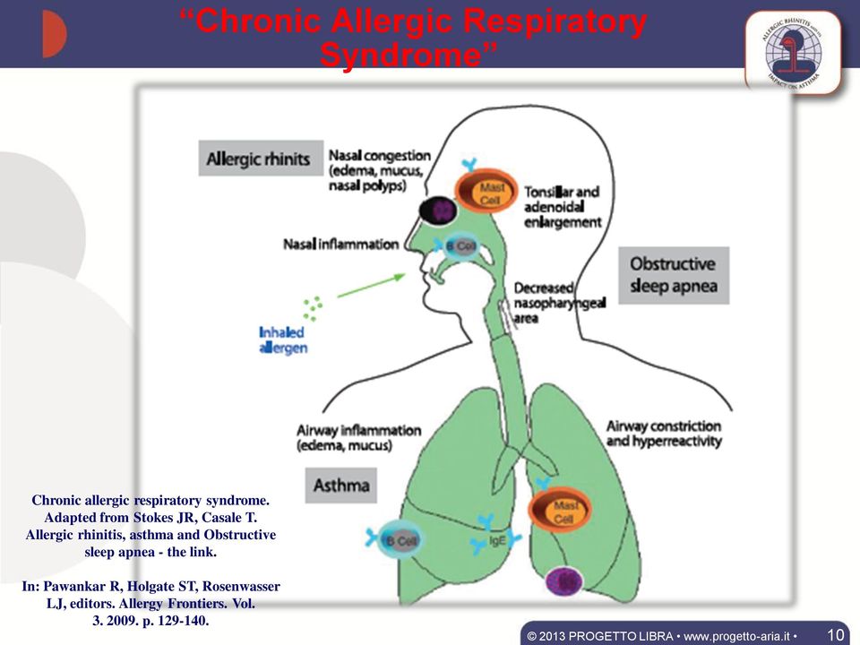 Allergic rhinitis, asthma and Obstructive sleep apnea - the link.