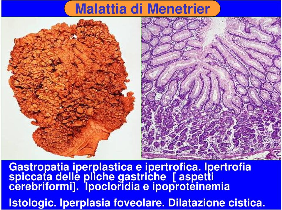 Ipertrofia spiccata delle pliche gastriche [ aspetti