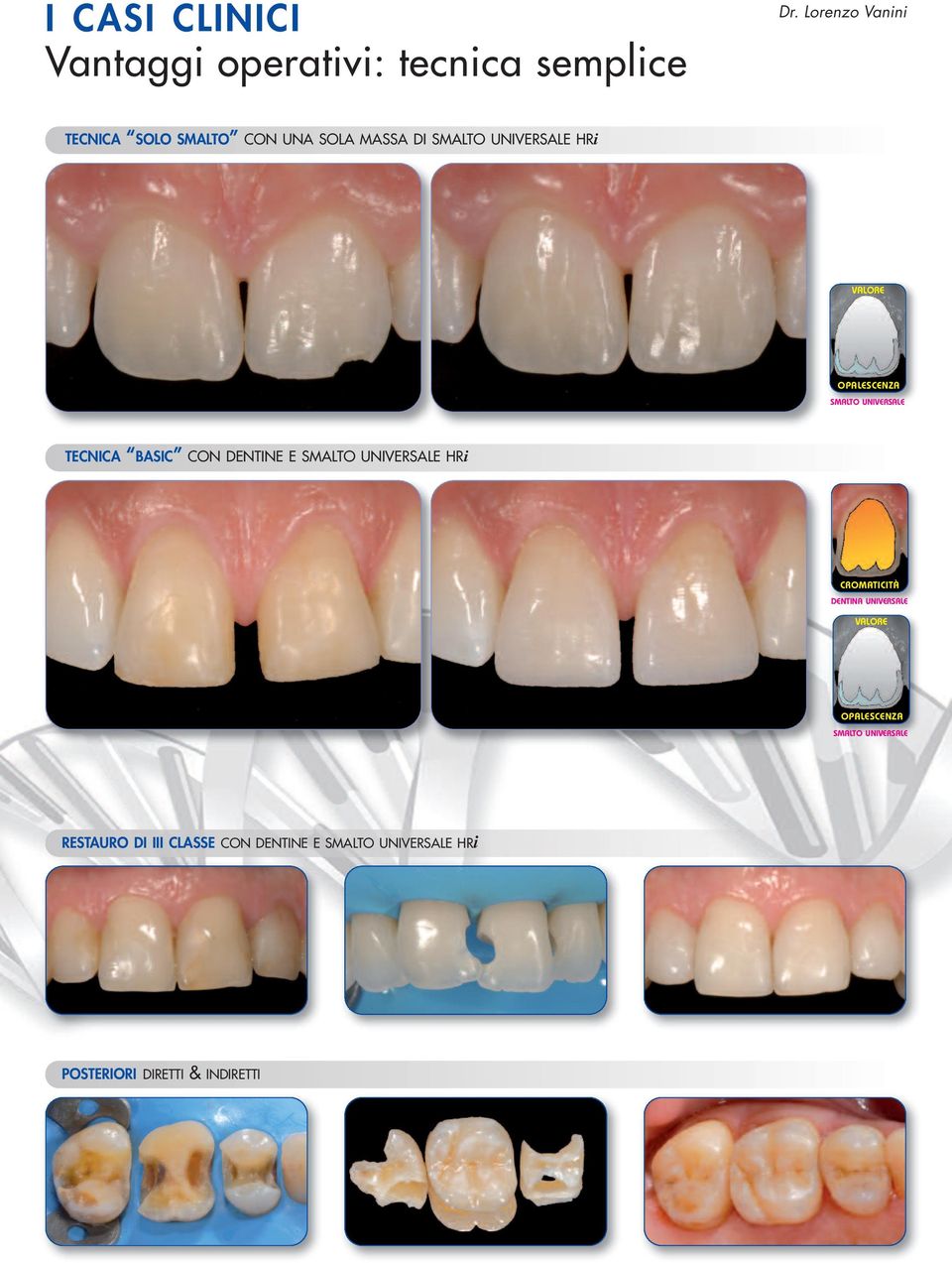 OPALESCENZA SMALTO UNIVERSALE TECNICA BASIC CON DENTINE E SMALTO UNIVERSALE HRi CROMATICITÀ