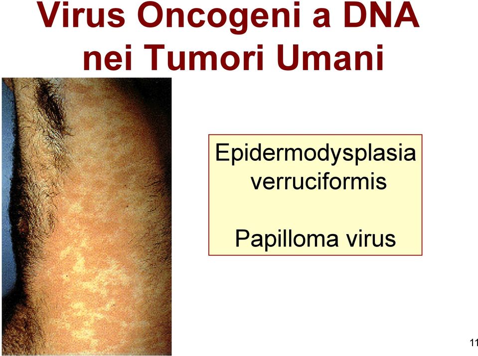 Epidermodysplasia