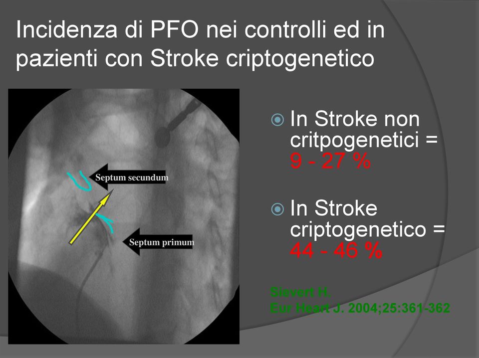 In Stroke non critpogenetici = 9-27 % In Stroke