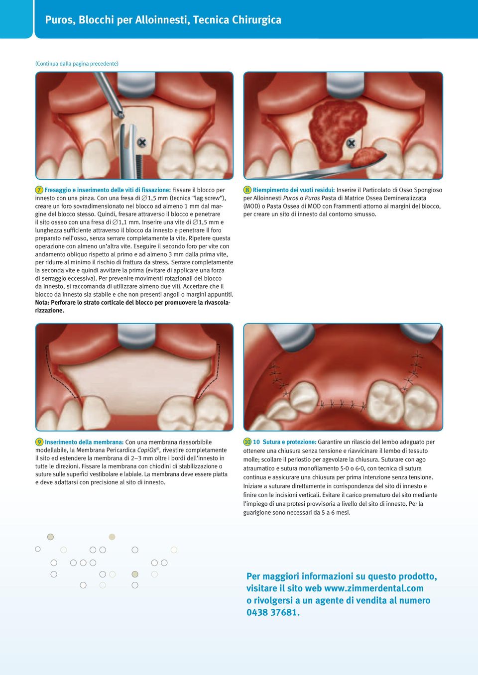 Quindi, fresare attraverso il blocco e penetrare il sito osseo con una fresa di 1,1 mm.