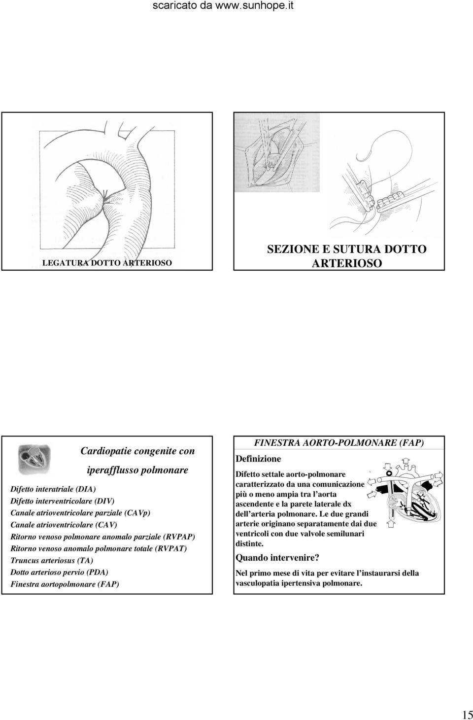 aortopolmonare (FAP) FINESTRA AORTO-POLMONARE (FAP) Difetto settale aorto-polmonare caratterizzato da una comunicazione più o meno ampia tra l aorta ascendente e la parete laterale dx dell