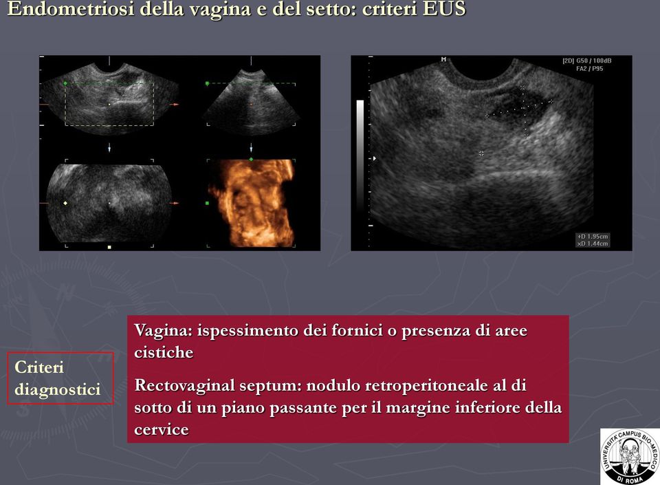 aree cistiche Rectovaginal septum: nodulo retroperitoneale al