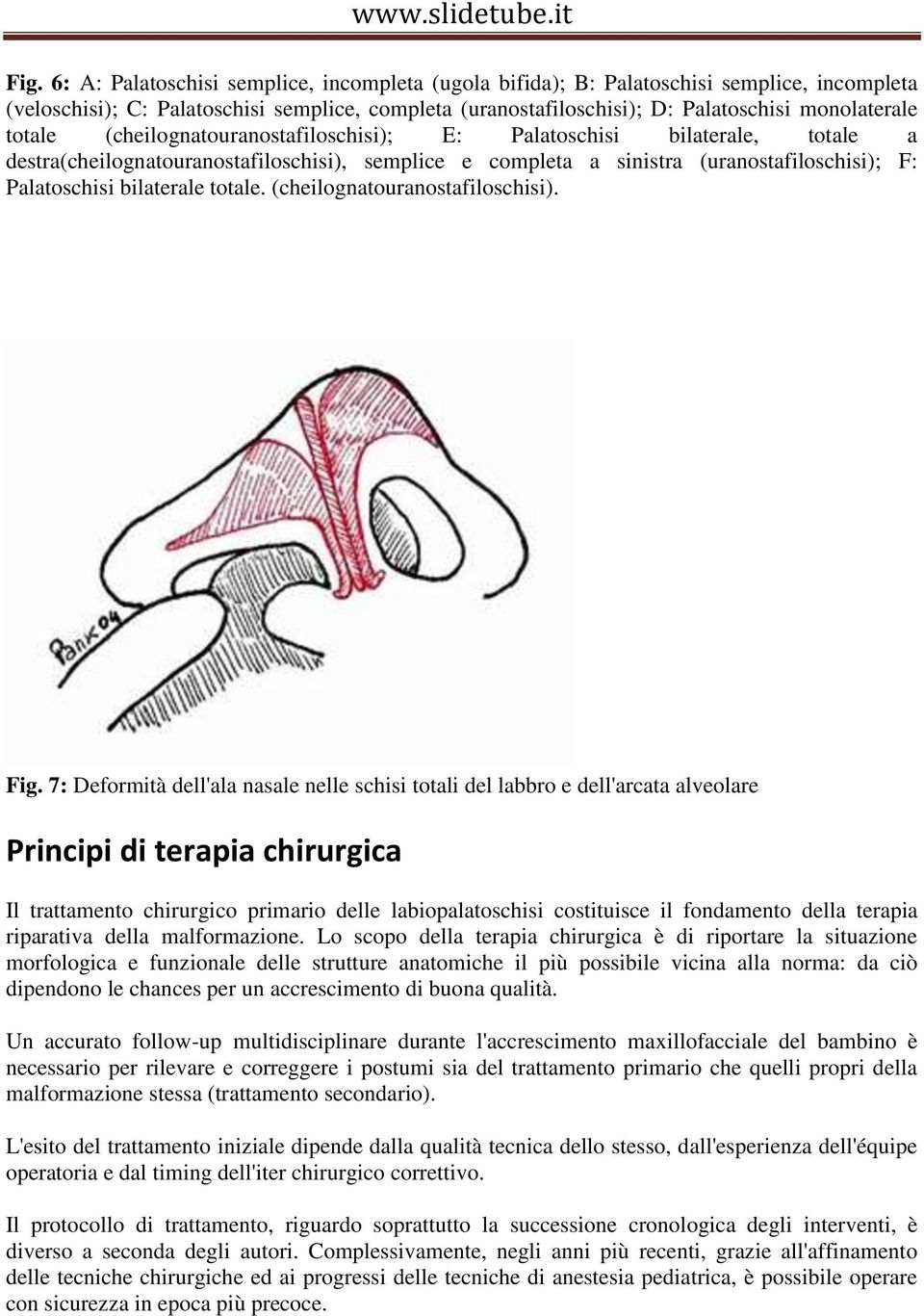 totale. (cheilognatouranostafiloschisi). Fig.