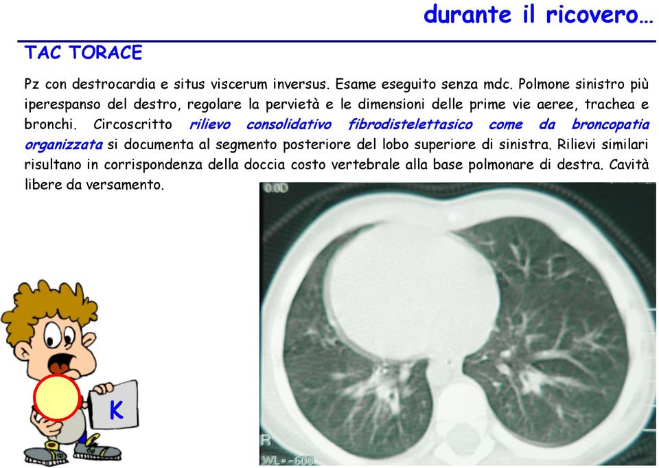 Circoscritto rilievo consolidativo fibrodistelettasico come da broncopatia organizzata si documenta al segmento posteriore del