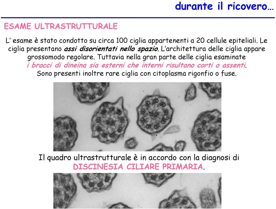 Tuttavia nella gran parte delle ciglia esaminate i bracci di dineina sia esterni che interni risultano corti o assenti.