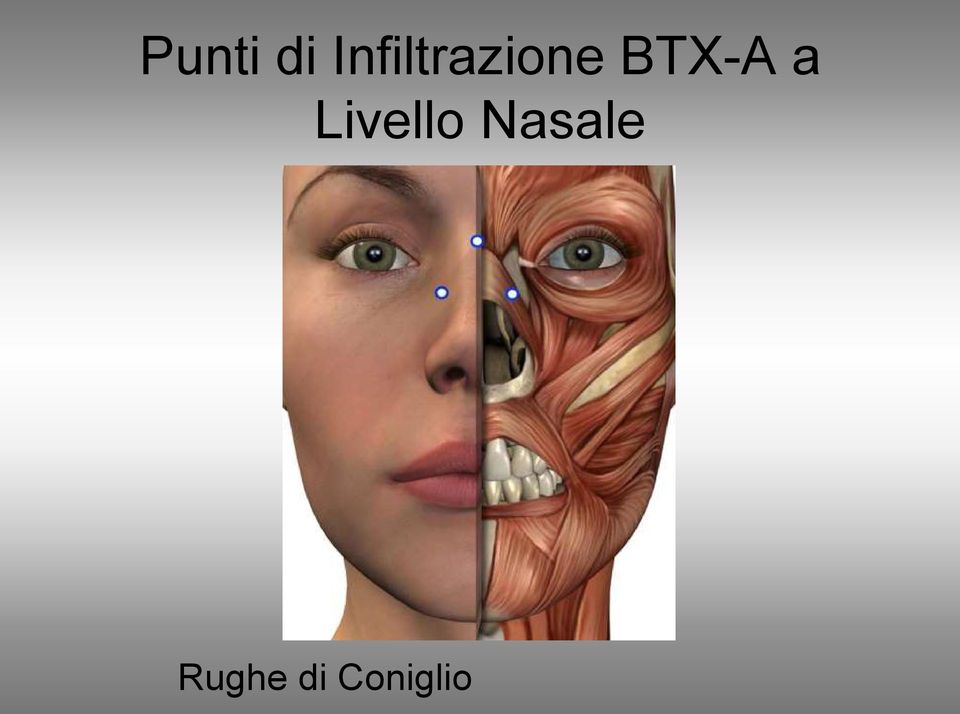 BTX-A a Livello