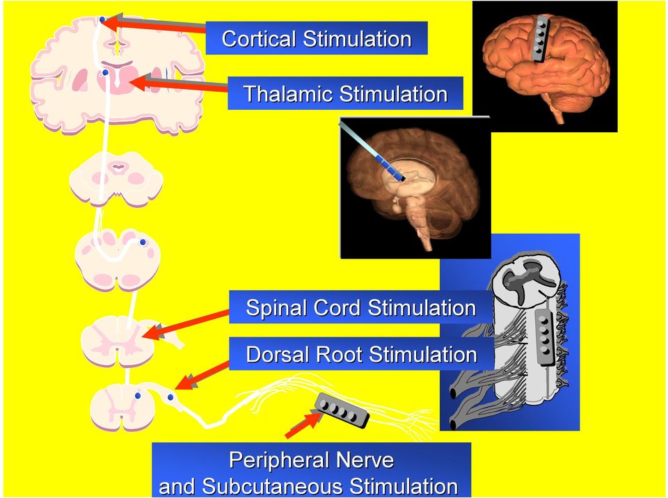 Stimulation Dorsal Root
