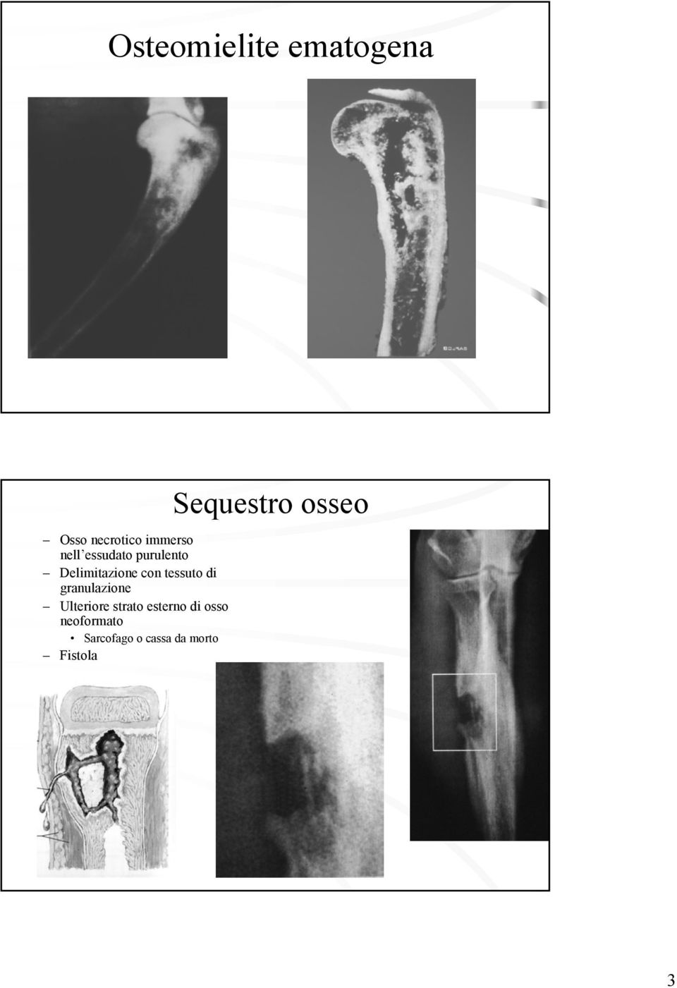 granulazione Ulteriore strato esterno di osso