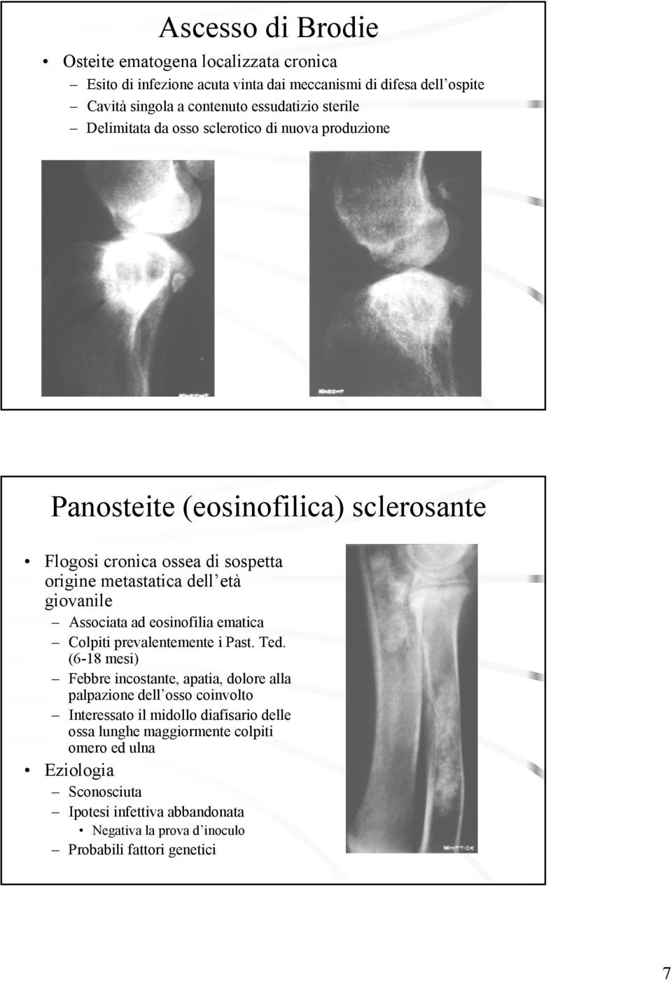 Associata ad eosinofilia ematica Colpiti prevalentemente i Past. Ted.