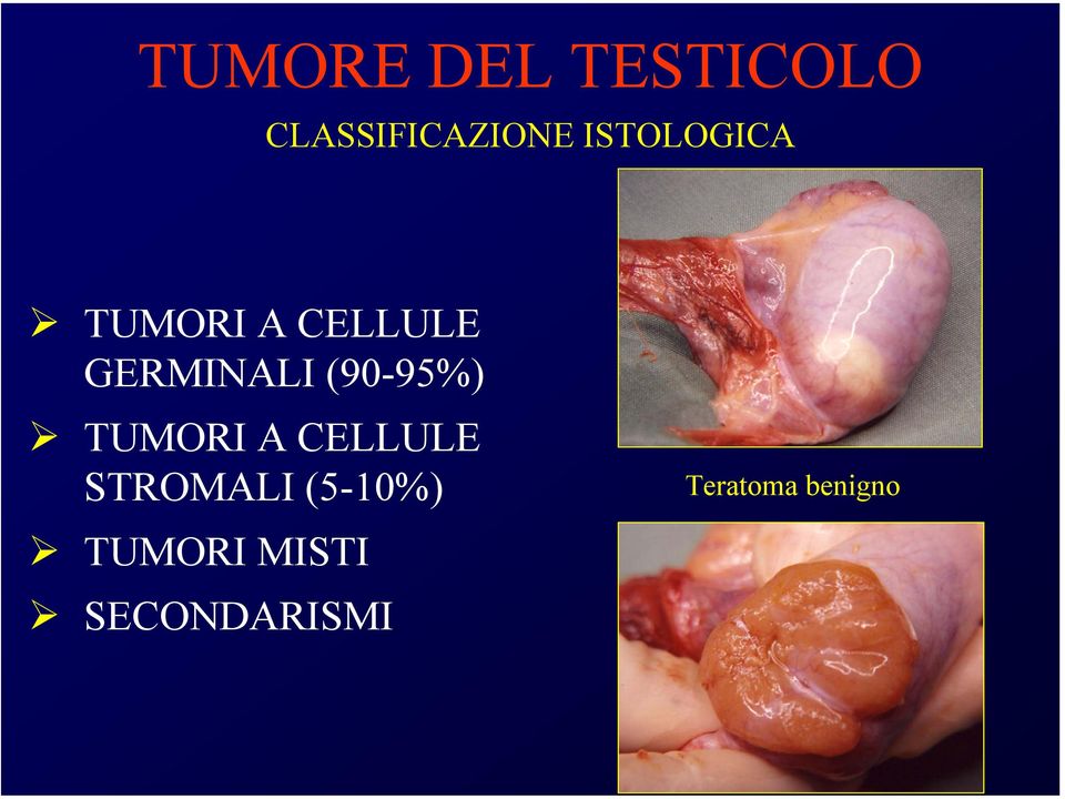 (90-95%) TUMORI A CELLULE STROMALI