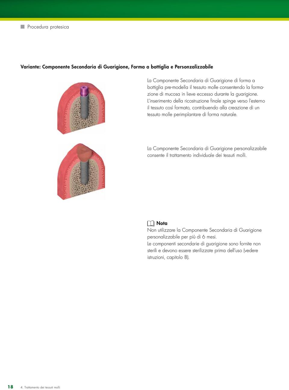 L inserimento della ricostruzione finale spinge verso l esterno il tessuto così formato, contribuendo alla creazione di un tessuto molle perimplantare di forma naturale.