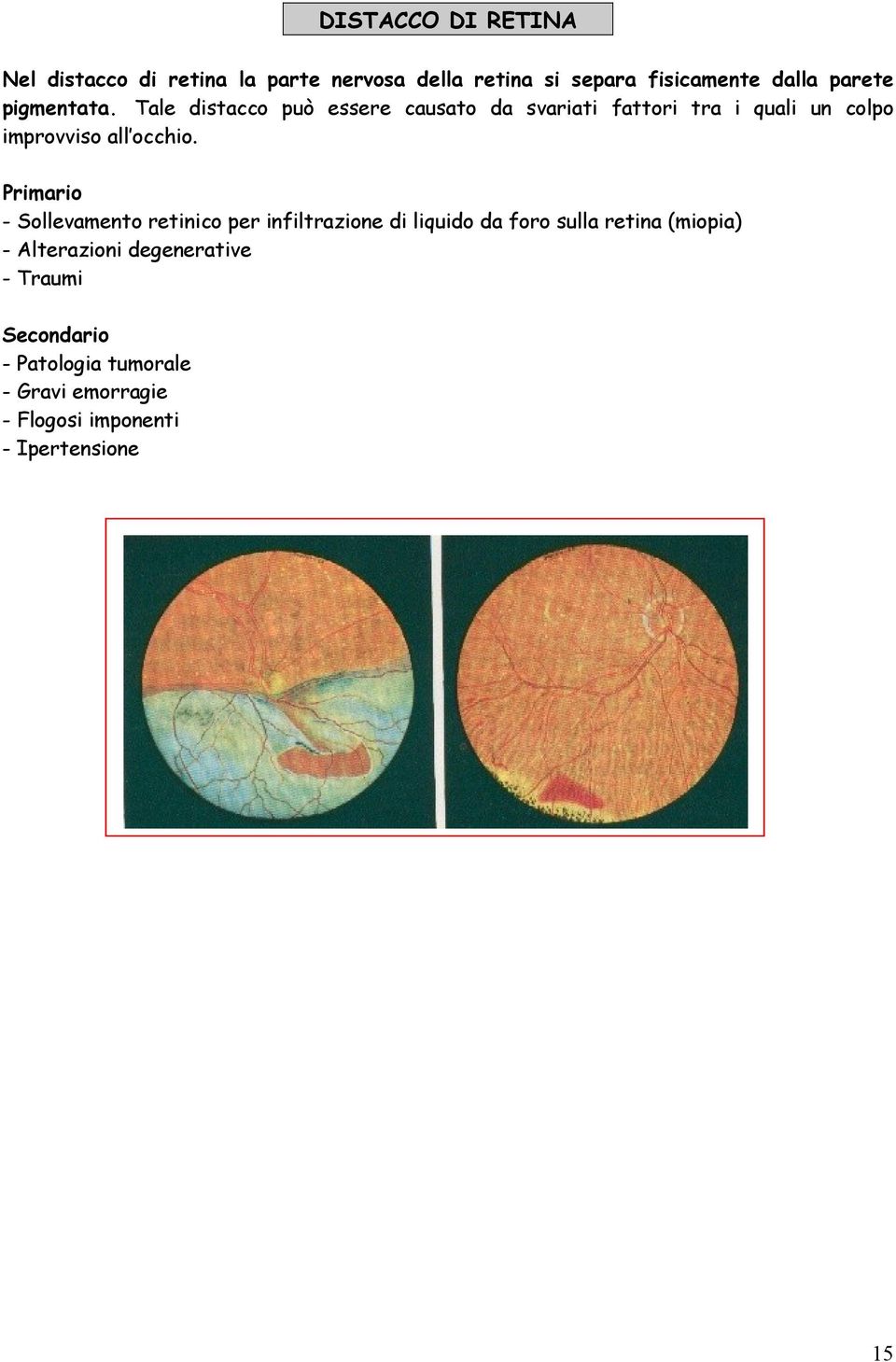 Primario - Sollevamento retinico per infiltrazione di liquido da foro sulla retina (miopia) - Alterazioni