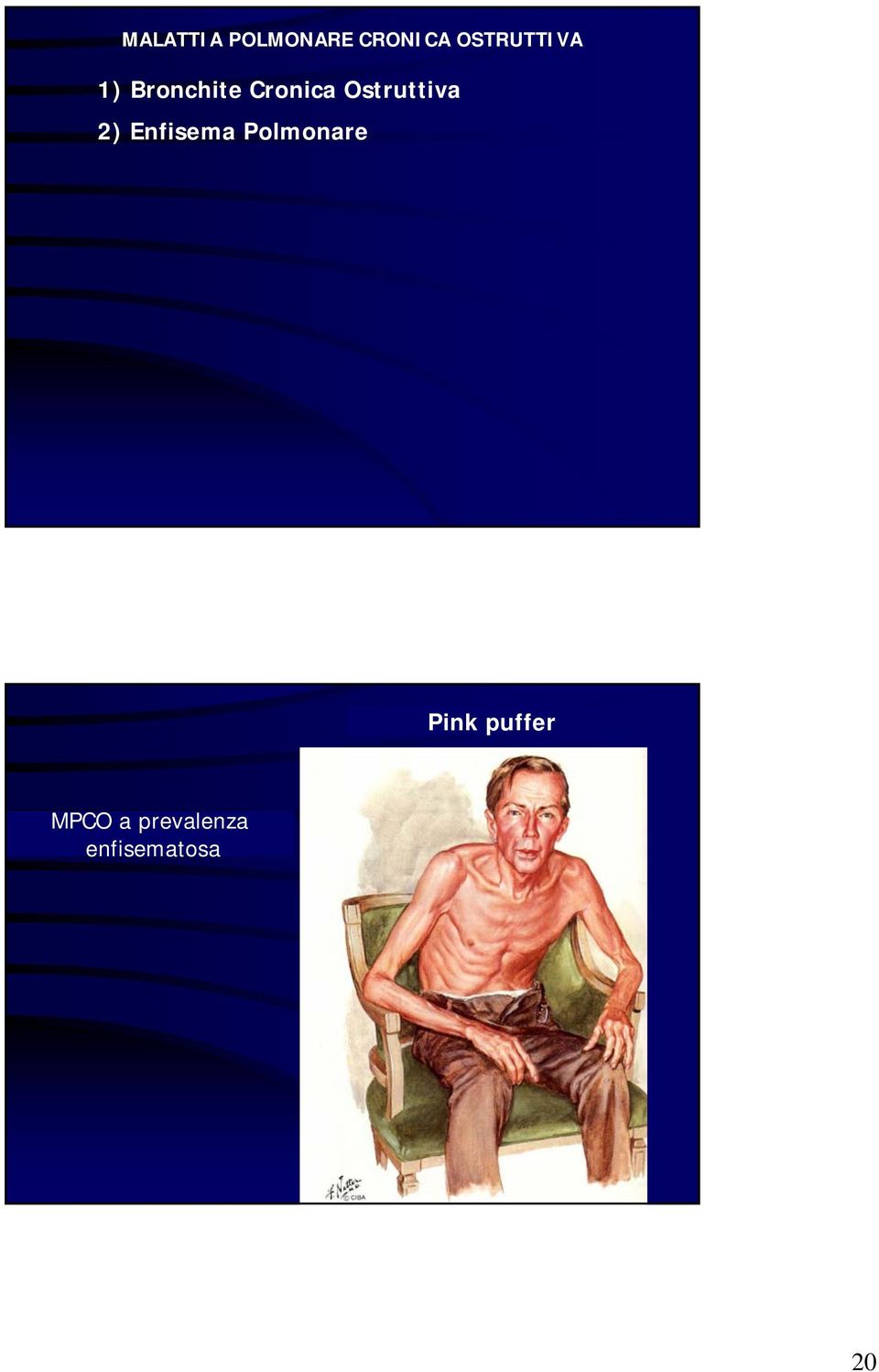 Ostruttiva 2) Enfisema Polmonare