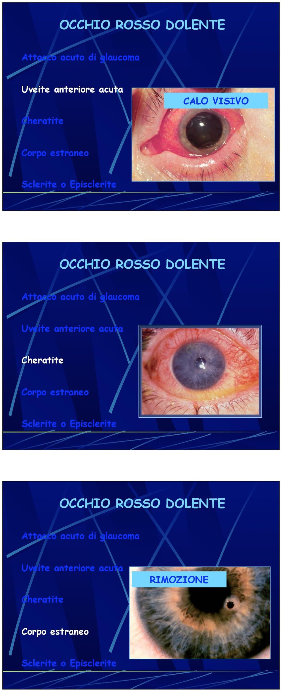 anteriore acuta Cheratite  anteriore acuta RIMOZIONE Cheratite Corpo estraneo Sclerite o