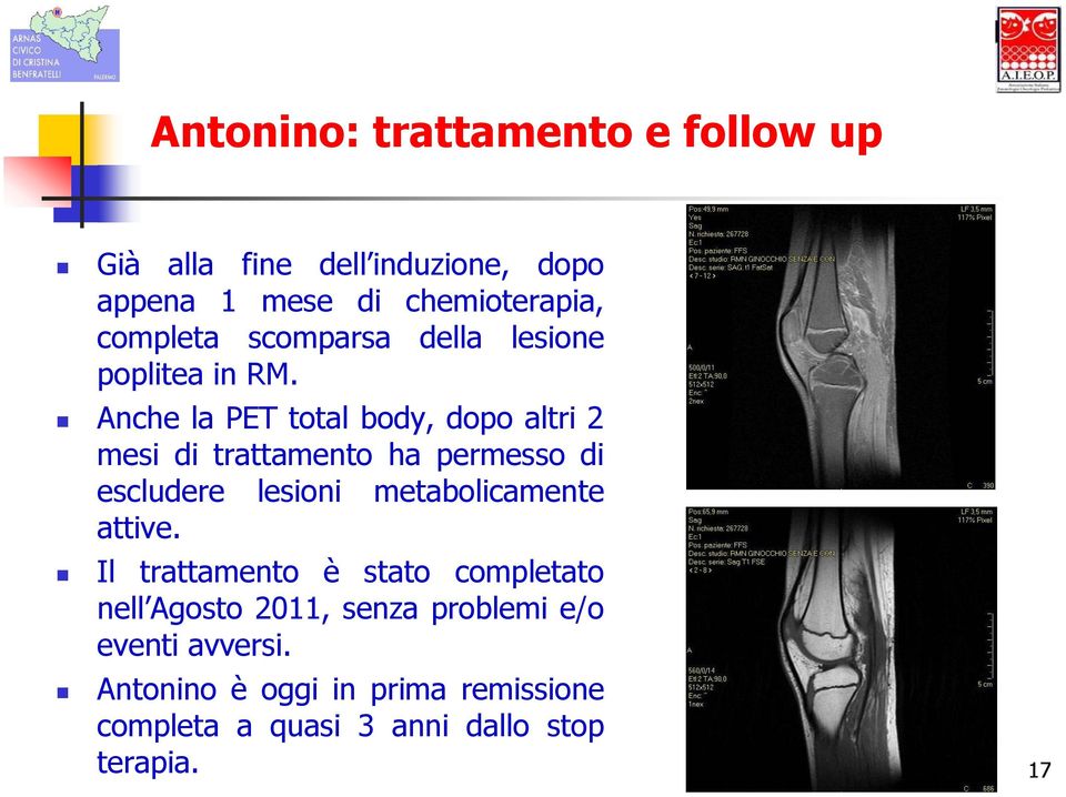 Anche la PET total body, dopo altri 2 mesi di trattamento ha permesso di escludere lesioni metabolicamente