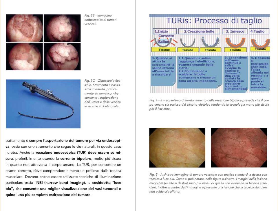 4 - Il meccanismo di funzionamento della resezione bipolare prevede che il corpo umano sia escluso dal circuito elettrico rendendo la tecnologia molto più sicura per il Paziente.