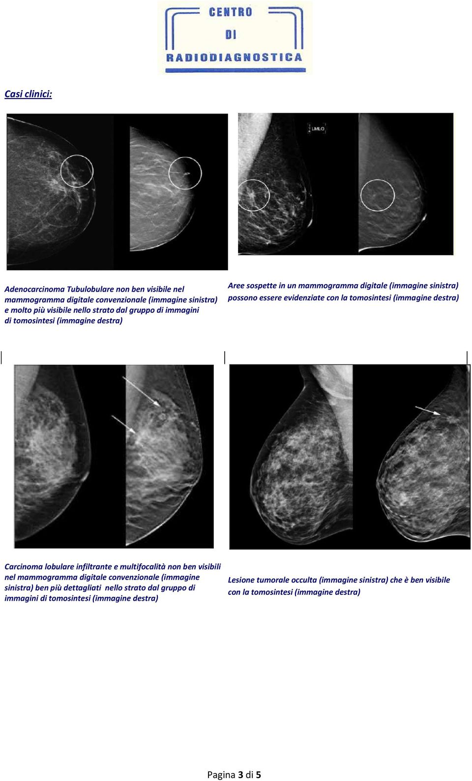 destra) Carcinoma lobulare infiltrante e multifocalità non ben visibili nel mammogramma digitale convenzionale (immagine sinistra) ben più dettagliati nello strato
