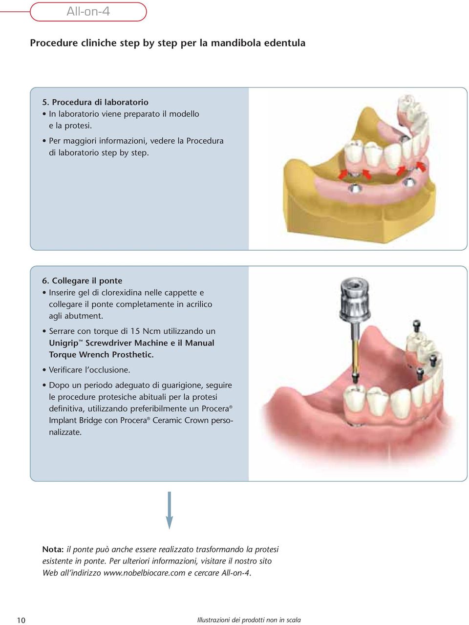 Collegare il ponte Inserire gel di clorexidina nelle cappette e collegare il ponte completamente in acrilico agli abutment.