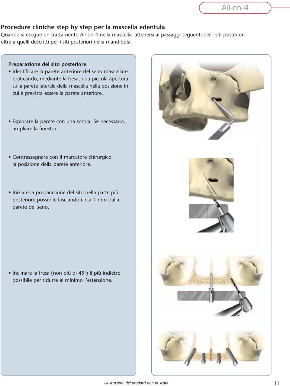 Preparazione del sito posteriore Identificare la parete anteriore del seno mascellare praticando, mediante la fresa, una piccola apertura sulla parete laterale della mascella nella posizione in cui è