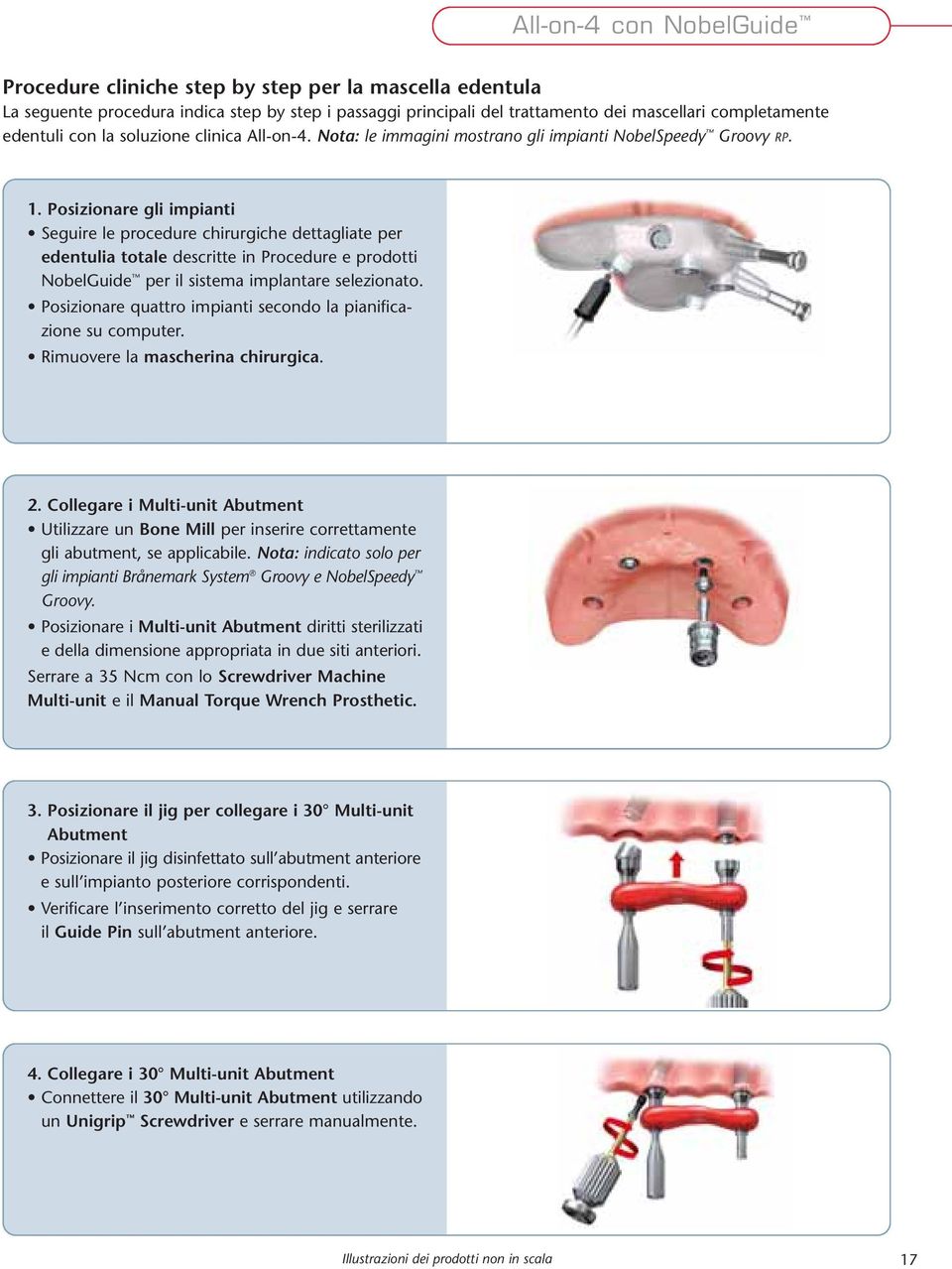 Posizionare gli impianti Seguire le procedure chirurgiche dettagliate per edentulia totale descritte in Procedure e prodotti NobelGuide per il sistema implantare selezionato.