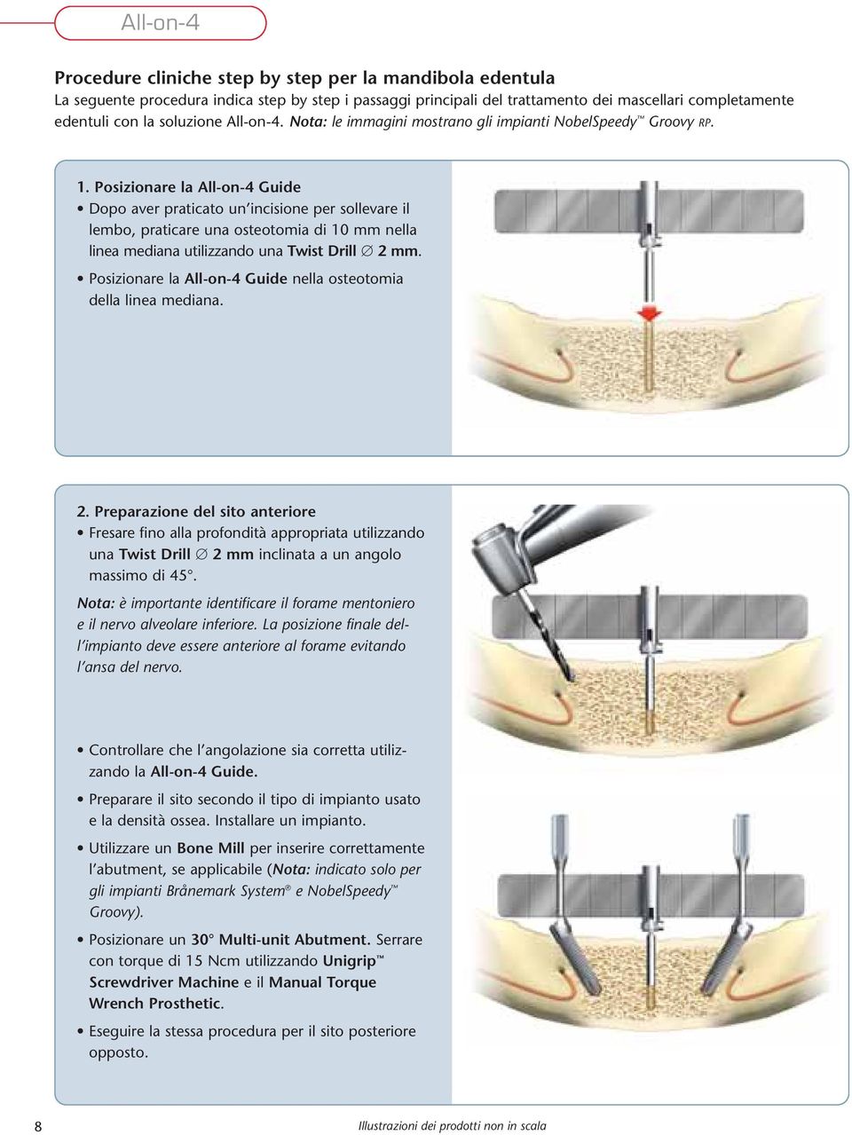 Posizionare la All-on-4 Guide Dopo aver praticato un incisione per sollevare il lembo, praticare una osteotomia di 10 mm nella linea mediana utilizzando una Twist Drill 2 mm.