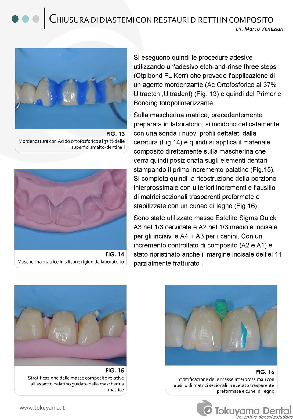 13 Mordenzatura con Acido ortofosforico al 37 % delle superfici smalto-dentinali FIG.