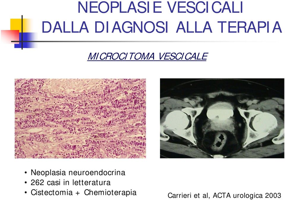 letteratura Cistectomia +