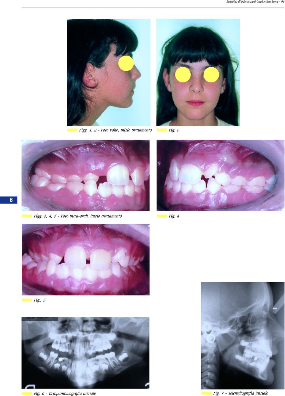 3, 4, 5 - Foto intra-orali, inizio trattamento