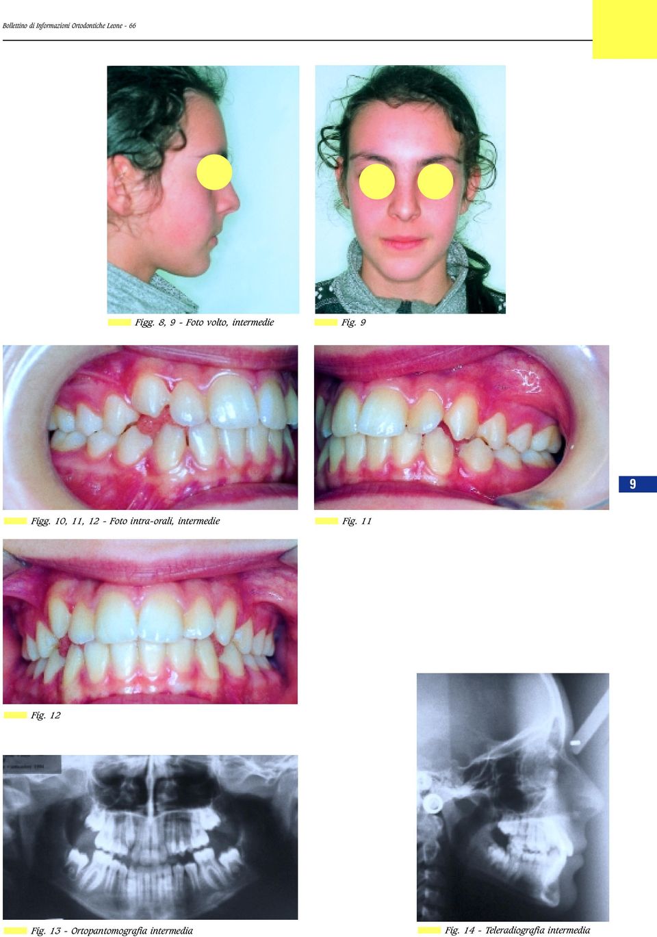 10, 11, 12 - Foto intra-orali, intermedie Fig.