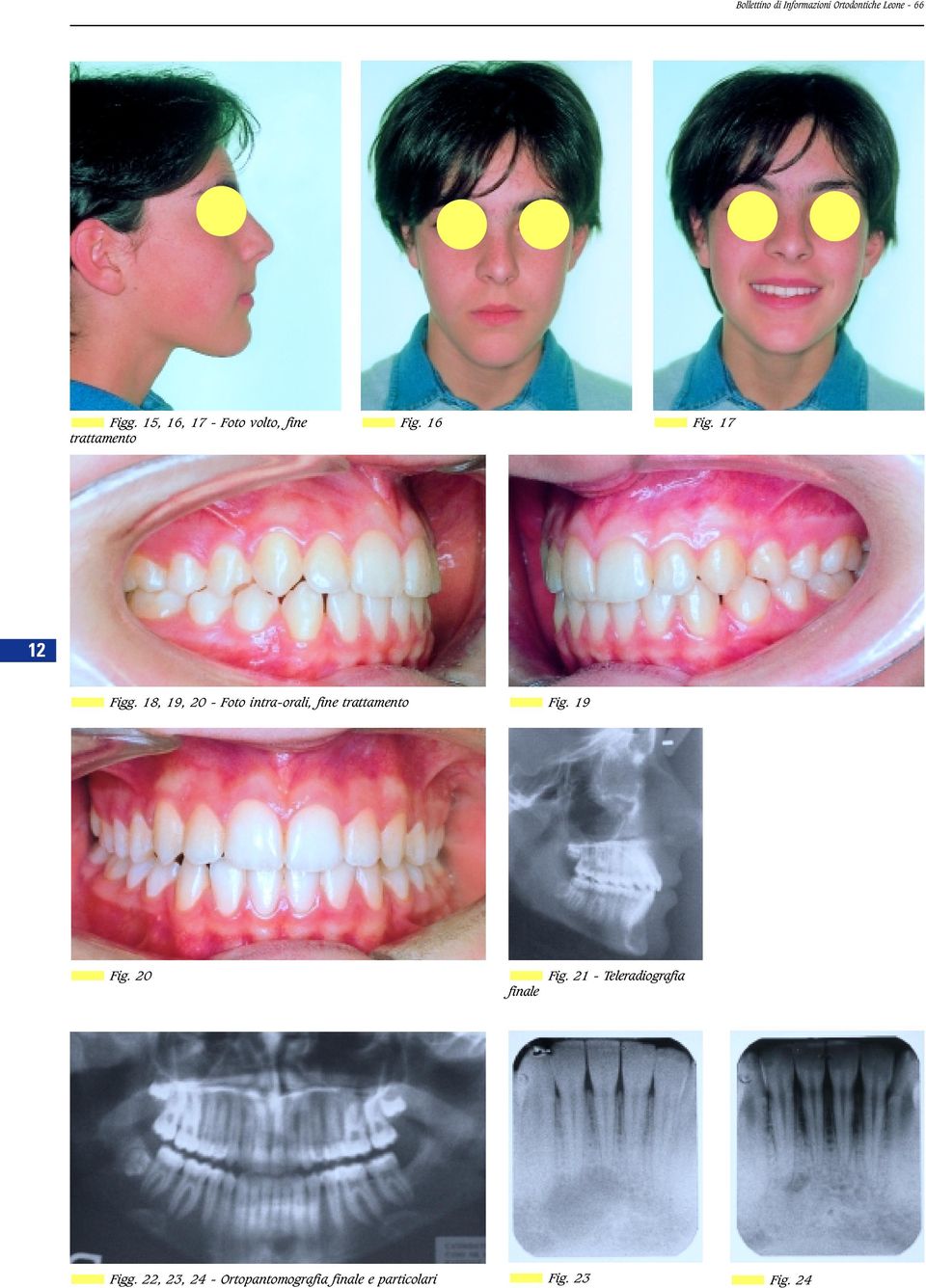 18, 19, 20 - Foto intra-orali, fine trattamento Fig. 19 Fig.