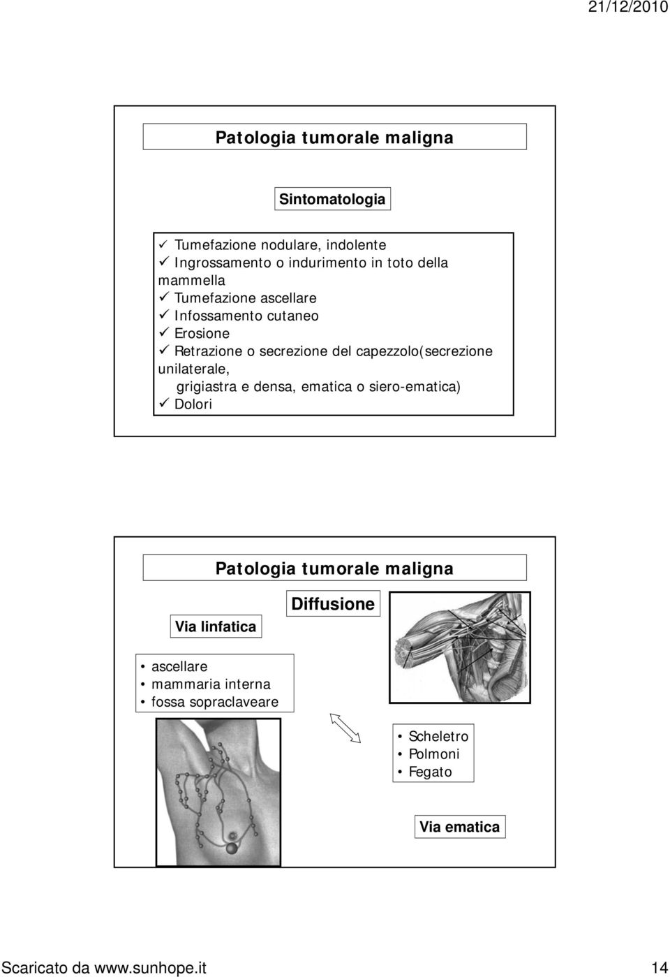 unilaterale, grigiastra e densa, ematica o siero-ematica) Dolori Via linfatica Diffusione ascellare