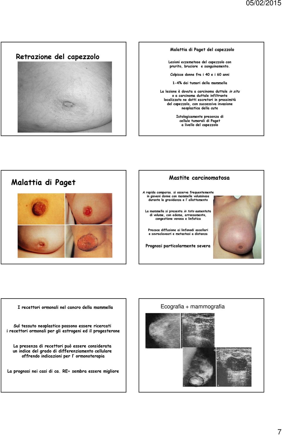 capezzolo, con successiva invasione neoplastica della cute Istologicamente presenza di cellule tumorali di Paget a livello del capezzolo Malattia di Paget Mastite carcinomatosa A rapida comparsa.