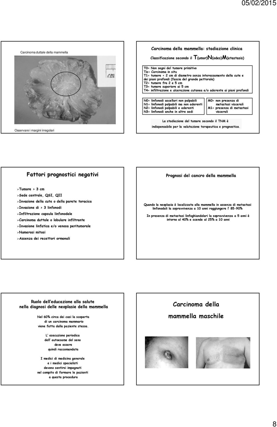 cutanea e/o aderente ai piani profondi N0= linfonodi ascellari non palpabili N1= linfonodi palpabili ma non aderenti N2= linfonodi palpabili e aderenti N3= linfonodi anche in altre sedi M0= non