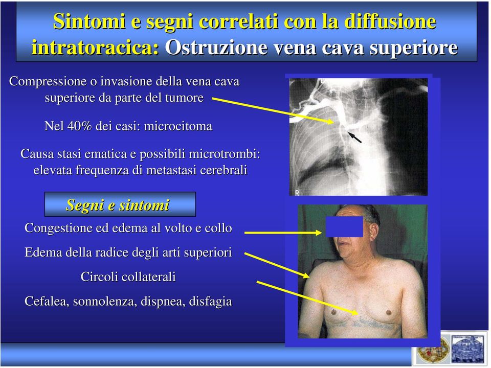 possibili microtrombi: elevata frequenza di metastasi cerebrali Segni e sintomi Congestione ed edema al