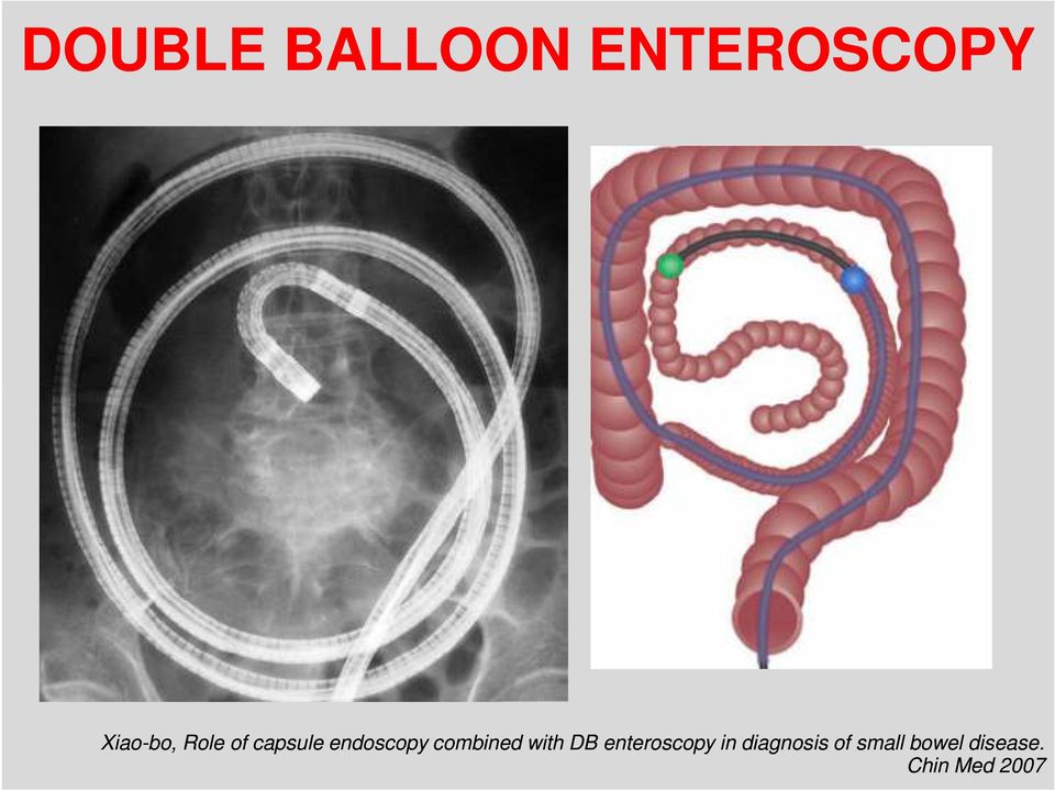 with DB enteroscopy in diagnosis of