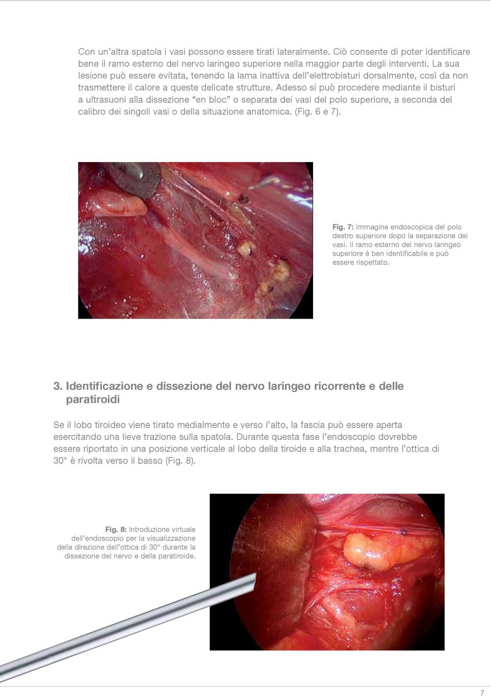 Adesso si può procedere mediante il bisturi a ultrasuoni alla dissezione en bloc o separata dei vasi del polo superiore, a seconda del calibro dei singoli vasi o della situazione anatomica. (Fig.