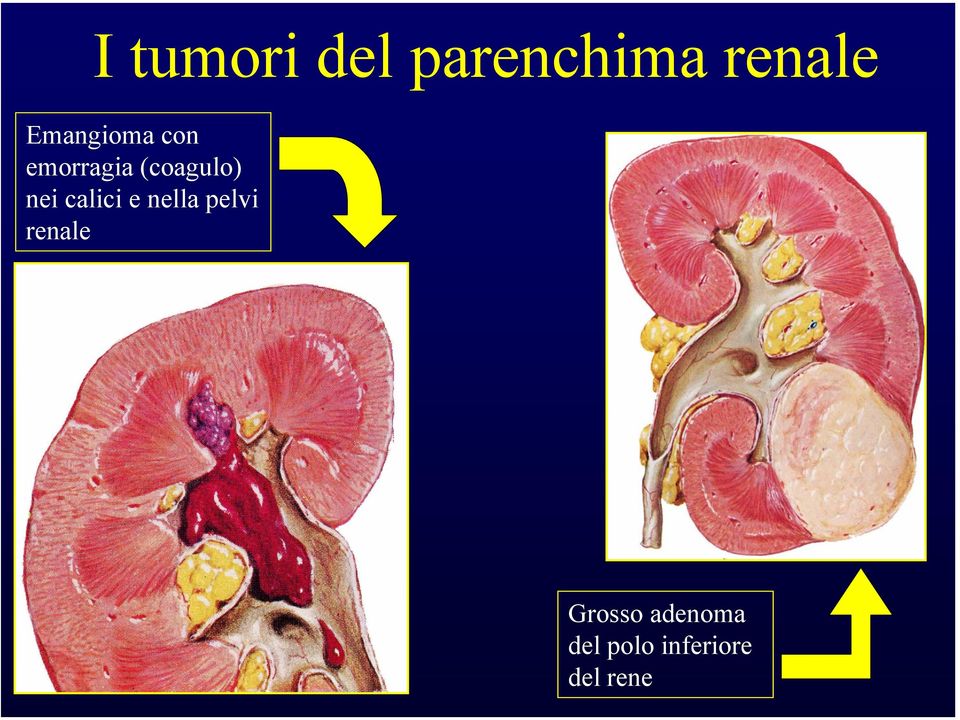 nei calici e nella pelvi renale