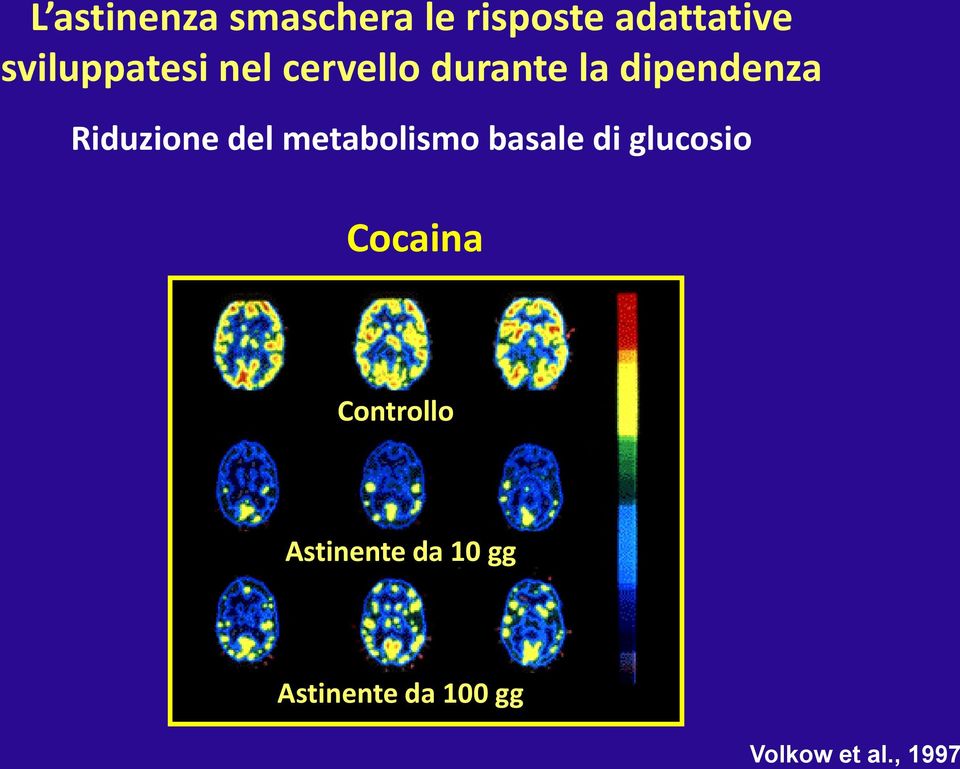 Riduzione del metabolismo basale di glucosio Cocaina